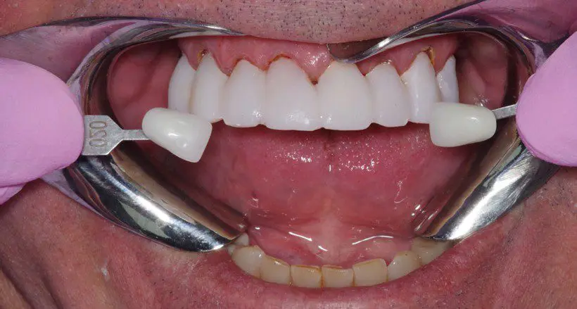 Read more about the article New eBook: How to Make Durable and Aesthetic Temporaries