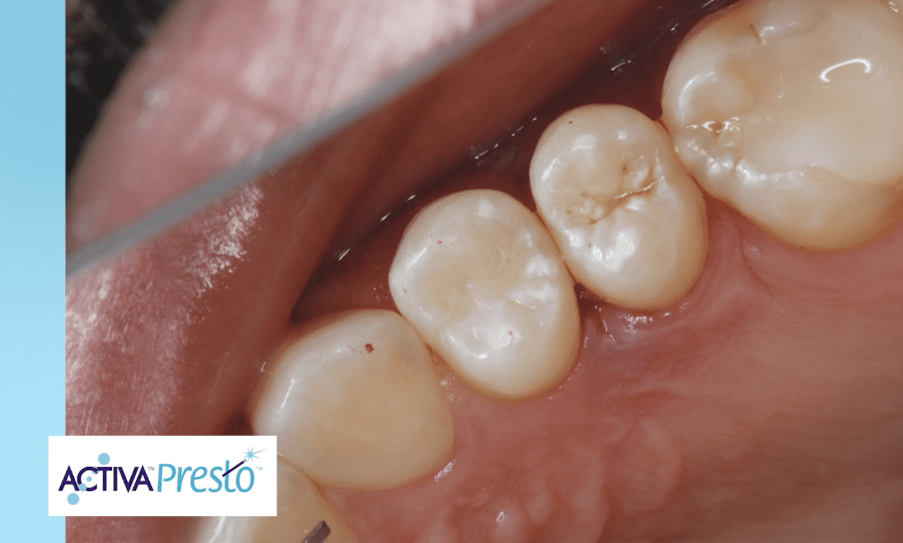 Read more about the article NEW VIDEO! Dr. Joshua Austin x Dental Economics present ACTIVA Presto