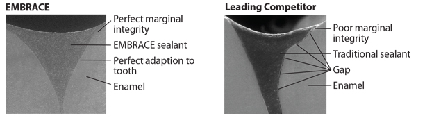 Light Curing Pit And Fissure Sealant » dline - Global Supplier of