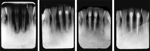 Abscessed-TeethFig1234