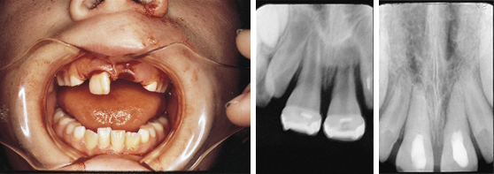 Avulsed-Tooth