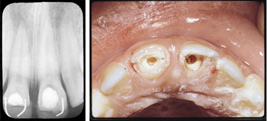 Dentin-Bridge_Case2
