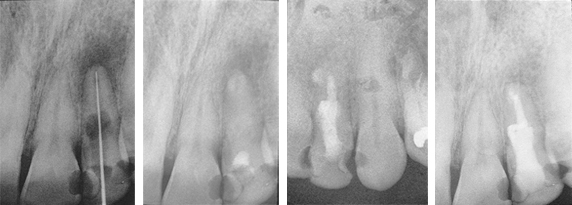 Periapical-Lesion1234