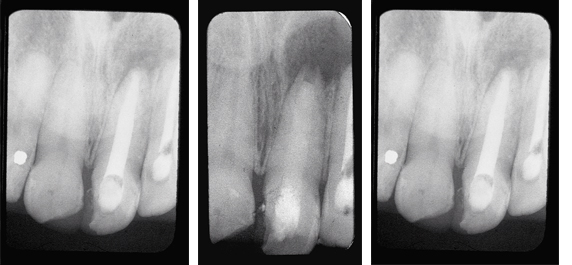 Persistent-Periapical-Lesion1234